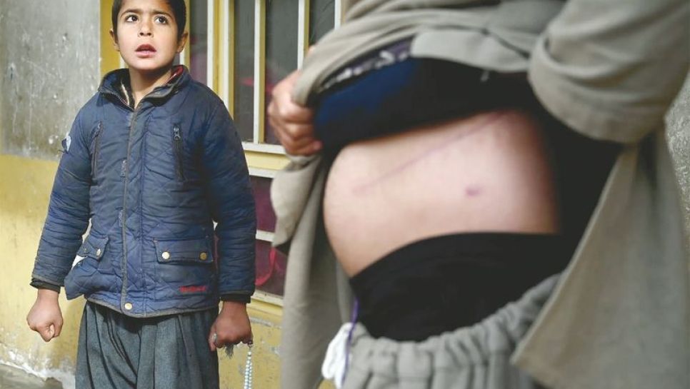 Nooruddin, qui a vendu son rein pour aider sa famille, montre sa cicatrice, le 4 février 2022 à Hérat, en Afghanistan. © D.R